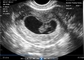 Scanner de gravidez portátil de endocavidade transvaginal para ultrassom portátil OB/GYN