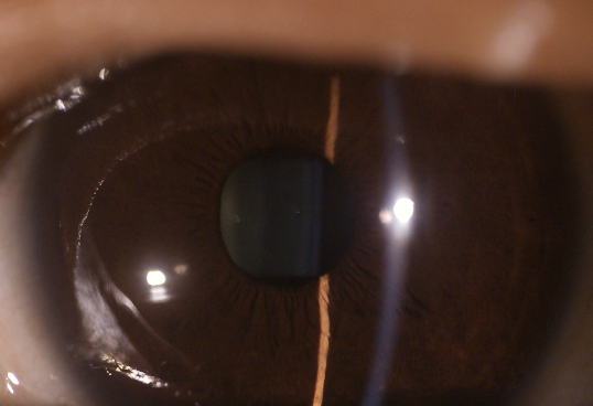 Do olho de superfície oftálmico disponível da câmera do olho da câmera do fundo de 3 Digitas do equipamento da lente lente anterior substituível
