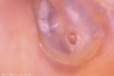 Otoscope de Digitas do amera video da orelha e do nariz C para a perfuração da membrana timpânica