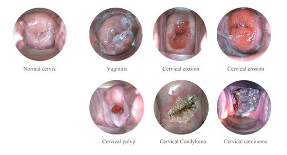 Colposcópio eletrônico digital portátil