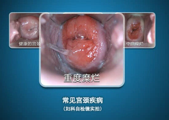 O endoscópio de Digitas Auto-inspeciona o mini Colposcopy do Colposcope com escala da observação 70~100mm