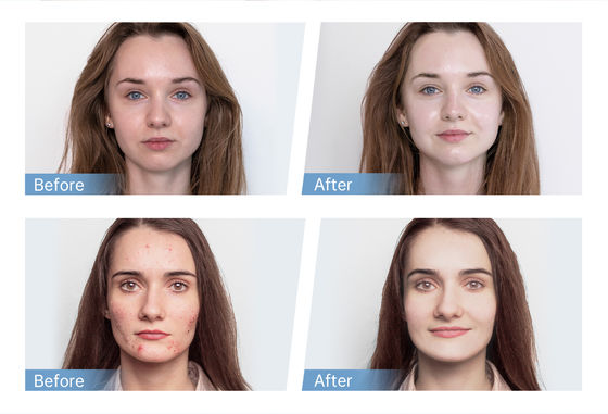 Último aplicador de soro automático de 4 polos EMS Hydra Pen H5 Face Skin Derma Microneedling Pen Essence Regeneração de colágeno